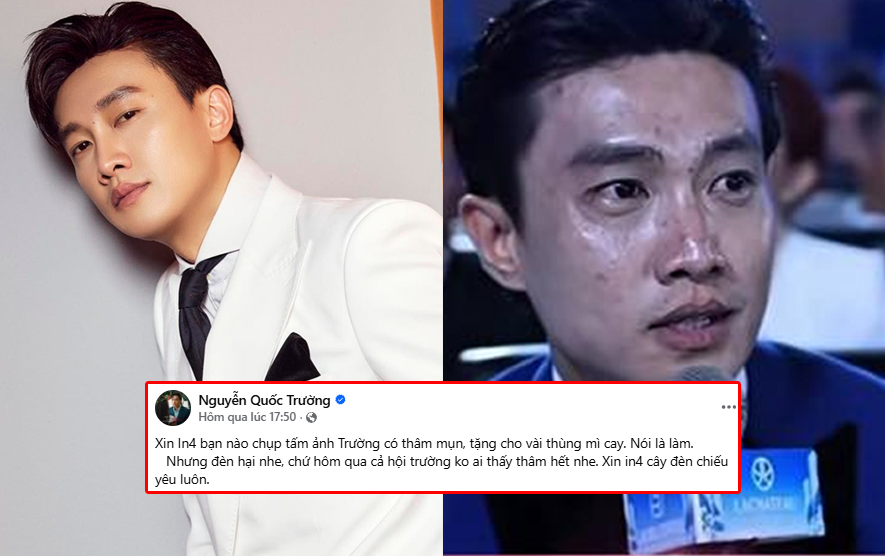 Bị soi cận da mặt mụn thâm trên sóng trực tiếp, Quốc Trường lập tức phủ nhận: Còn tuyên bố “treo thưởng” gây xôn xao!