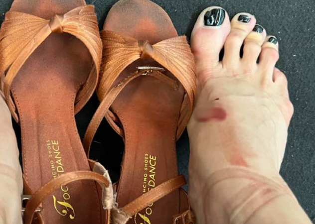 Cận cảnh đôi chân rớm máu, băng bó chằng chịt của kiện tướng Thu Hương khi cùng Phan Hiển giành 3 HCV Đông Nam Á: Nhìn mà vừa xót xa vừa khâm phục!