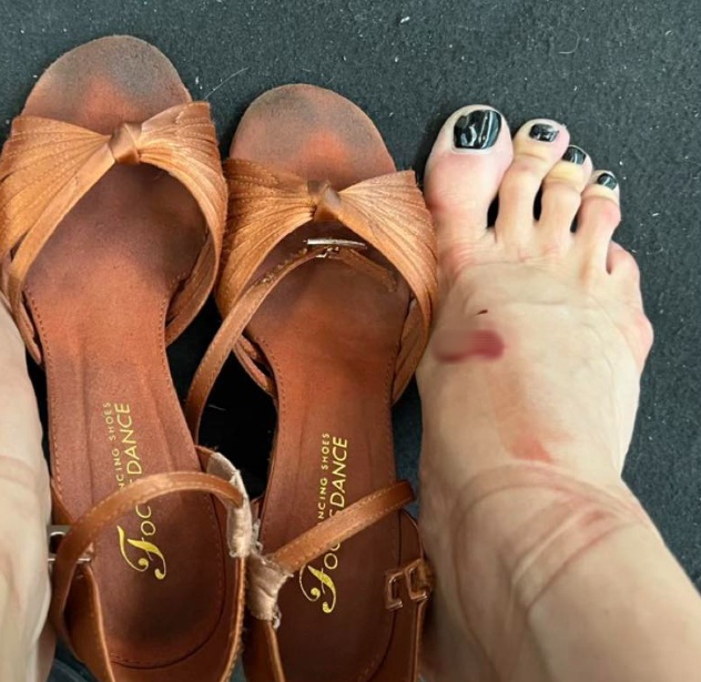 Cận cảnh đôi chân rớm máu, băng bó chằng chịt của kiện tướng Thu Hương khi cùng Phan Hiển giành 3 HCV Đông Nam Á: Nhìn mà vừa xót xa vừa khâm phục!